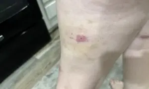 Gamba con lividi e arrossamenti, forse una puntura di scleroderma.