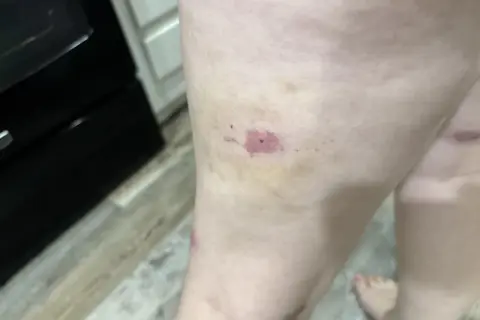 Gamba con lividi e arrossamenti, forse una puntura di scleroderma.