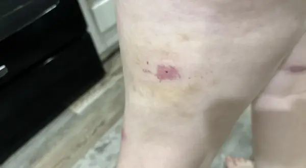 Gamba con lividi e arrossamenti, forse una puntura di scleroderma.