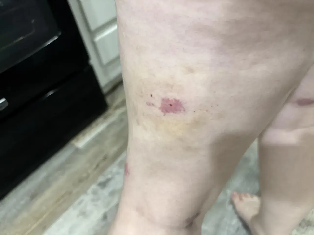 Gamba con lividi e arrossamenti, forse una puntura di scleroderma.