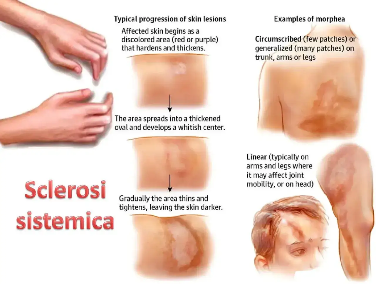 Progressione lesioni cutanee sclerodermia: area arrossata che si ispessisce, diventa biancastra e poi pi&ugrave; scura.